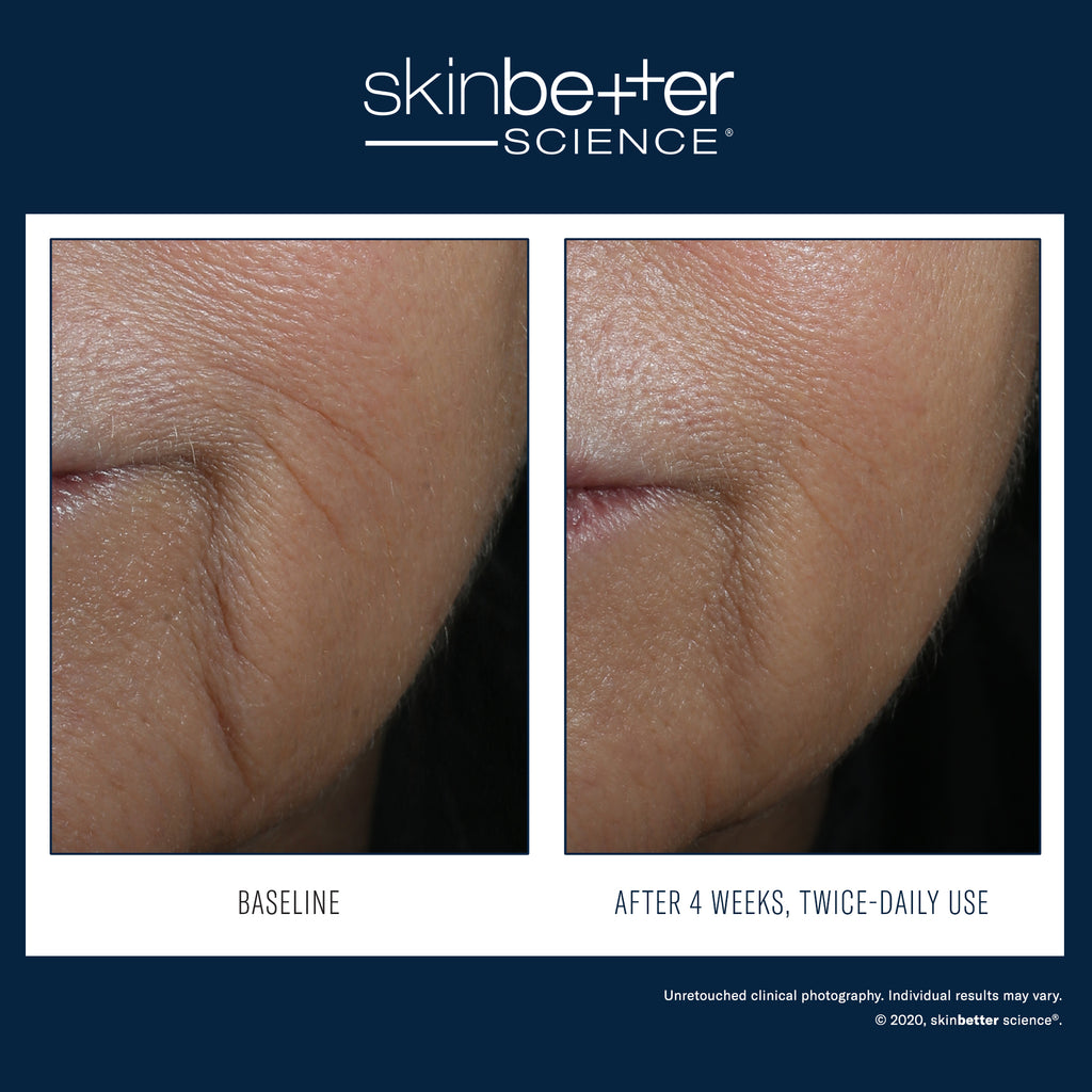 Interfuse Intensive Treatment - Lines